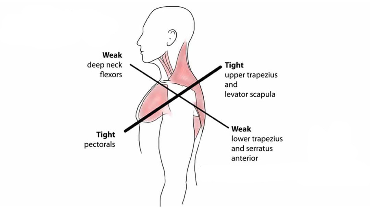 upper-crossed-syndrome-1080×600-1